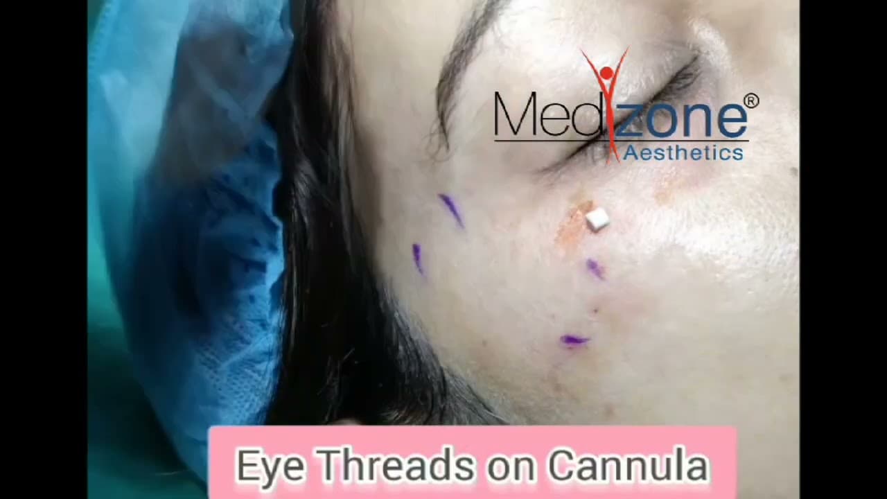Eye Threads on Cannula
