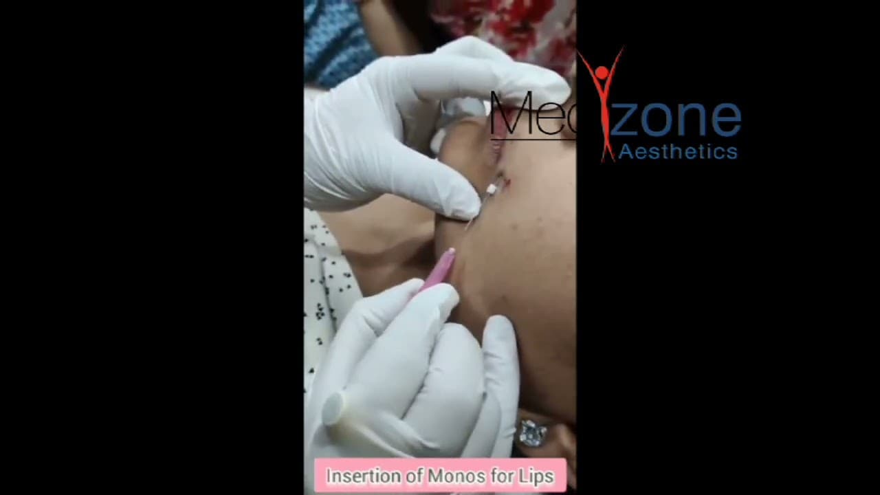 Insertion of Monos for Lips