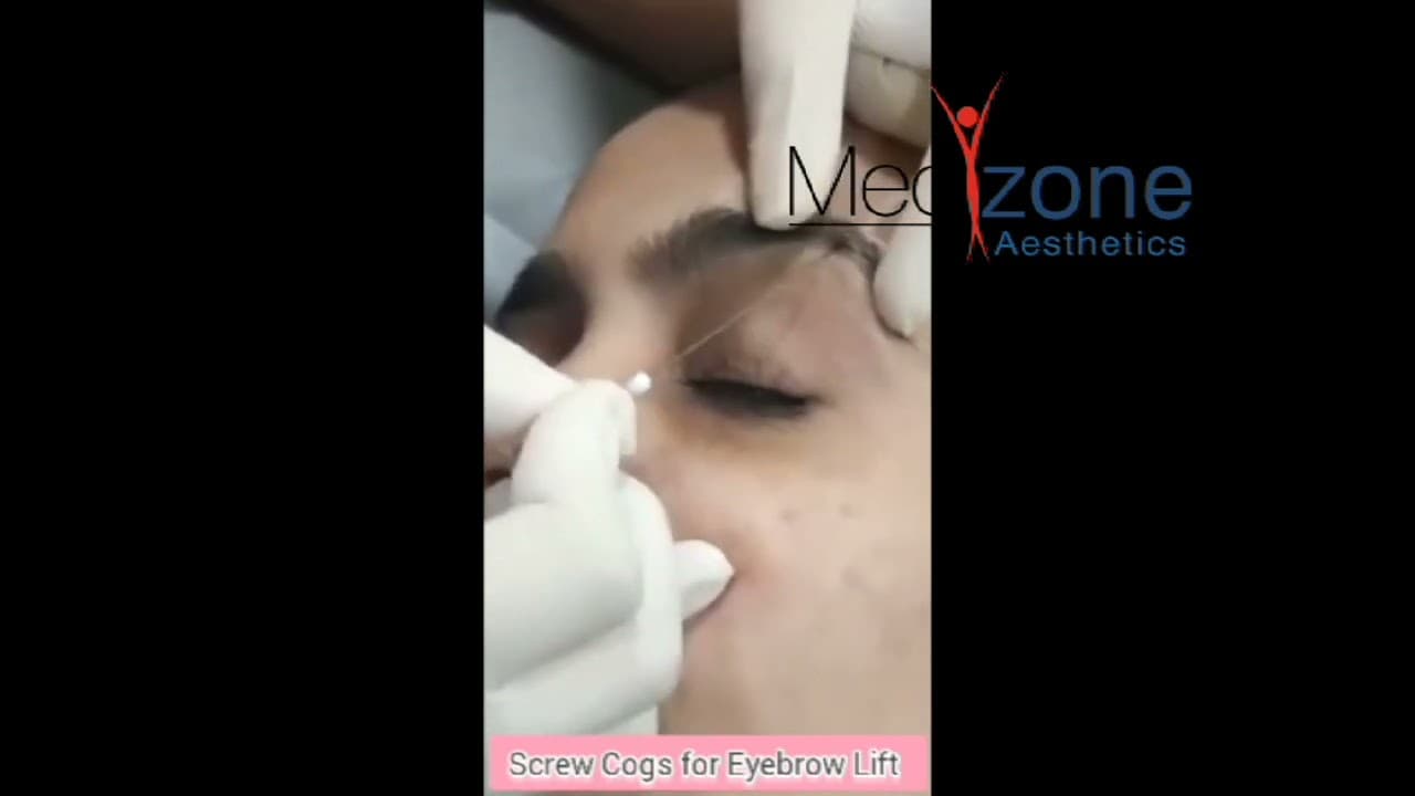 Screw Cogs for Eyebrow Lift
