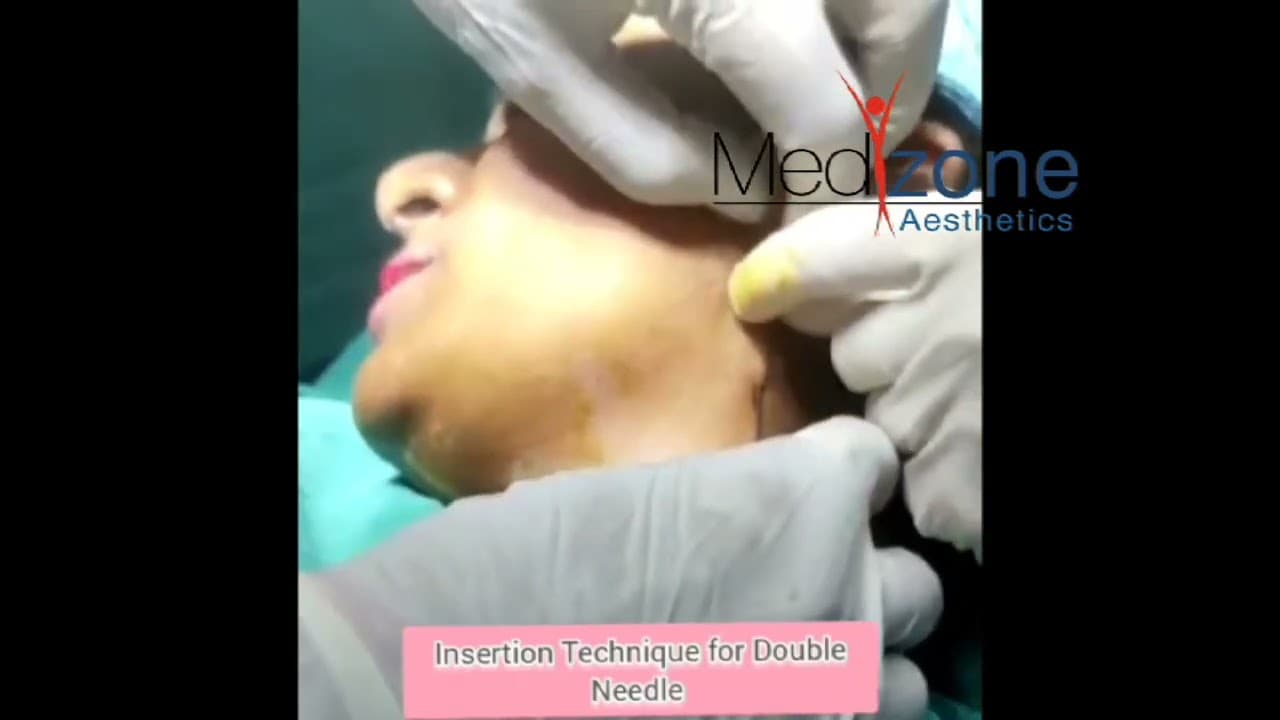 Insertion Technique for Double Needle